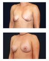 Breast Implants