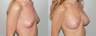 Breast Implants