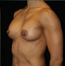 Breast Implants