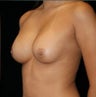 Breast Implants