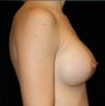 Breast Implants
