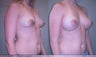 Breast Implants
