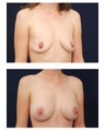 Breast Augmentation