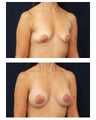 Breast Augmentation
