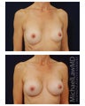 Breast Augmentation