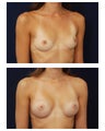 Breast Augmentation