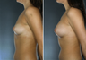 Breast Implants