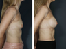 Breast Implants