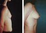 Breast Implants