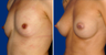 Breast Implants