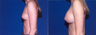 Breast Augmentation with Implants