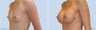 Breast Augmentation