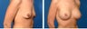 Breast Implants