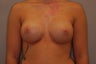 Breast Implants