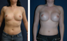 Breast Implants