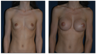 Breast Implants