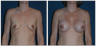Breast Implants
