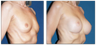 Breast Implants