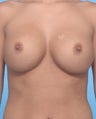 Breast augmentation with Saline implants