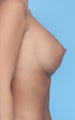 Breast augmentation with Saline breast implants