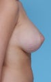 Saline implants for breast augmentation