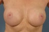 Breast Implants