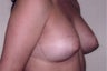 Breast Augmentation