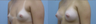 Breast Implants