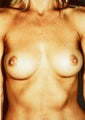 Breast Implants