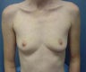 Breast Augmentation 