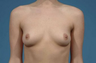 Breast Implants