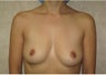 Breast Augmentation