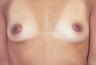 Breast Augmentation