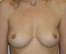 Breast Augmentation