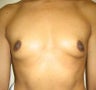 Breast Augmentation