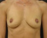Silicone Gel Breast Augmentation