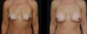 Breast Augmentation