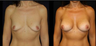 Breast Implants