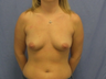 Breast Implants