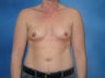 Breast Augmentation