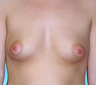 Breast Implants