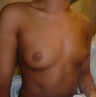 Breast Augmentation 
