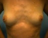 Breast implants