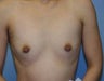 Breast implants