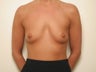 Breast Implants