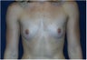Breast Implants