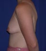 Breast Implants