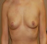 Breast Implants