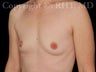 Breast Implants