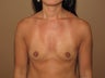 Breast augmentation implants